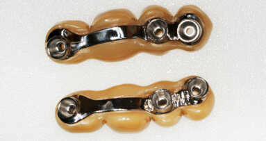 Okamžité zatížení implantátů v distálním úseku horní čelisti dvěma šroubovanými můstky vyrobenými digitálním pracovním postupem