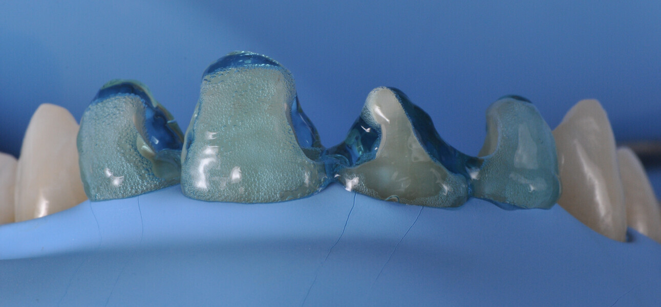 Fig. 11: Etching with a phosphoric acid etchant.