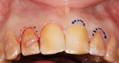 Trattamento estetico-funzionale in un caso di amelogenesi imperfetta generalizzata