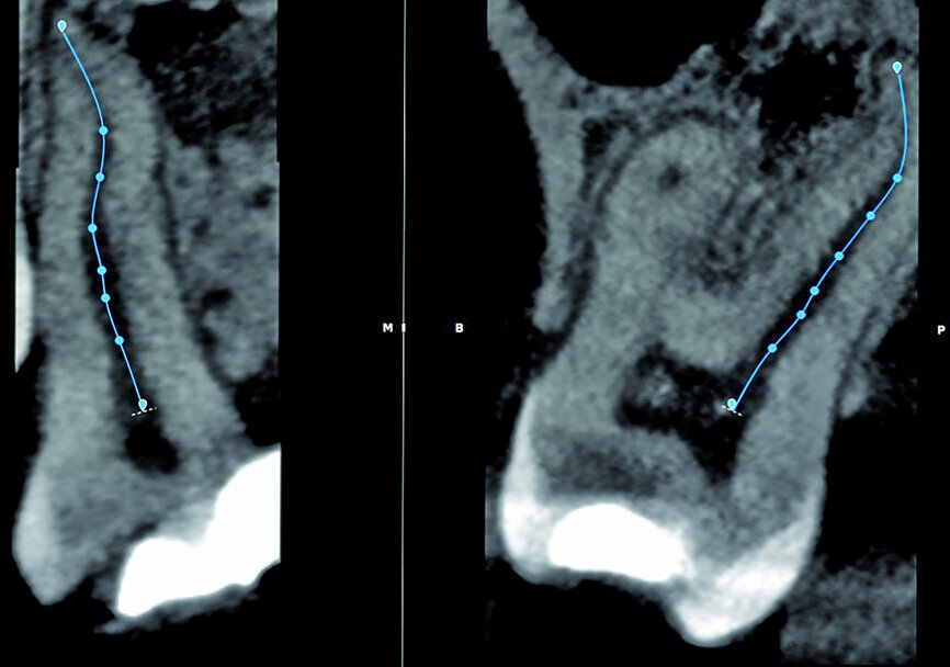 Fig. 8: Corrections made for the palatal root canal according to the canal configuration that can be viewed in different planes in the software.