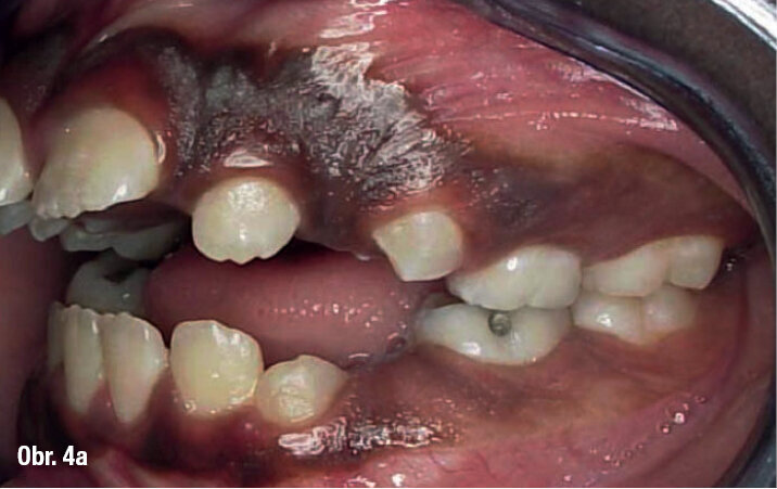 TS2 s anteriorními čtvercovými tahy a aktivními samoligovacími zámky jsou vysoce efektivní k rychlé úpravě závažných skeletálních anteriorně a laterálně otevřených skusů