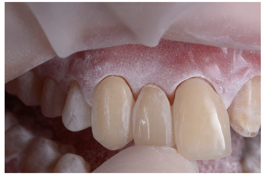 Fig. 23_Dopo il collasso dei tessuti, il provvisorio non può essere alloggiato a fondo corsa.