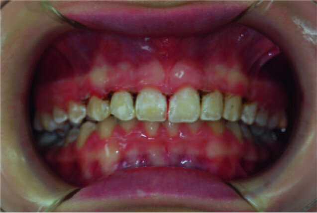 Clinical view just after surgery.
