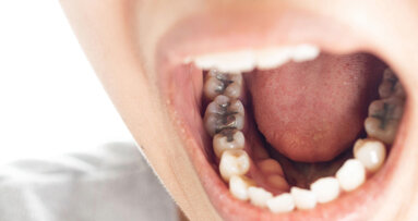 Amalgam versus composite: UK study warns of care crisis over 2034 phase-out