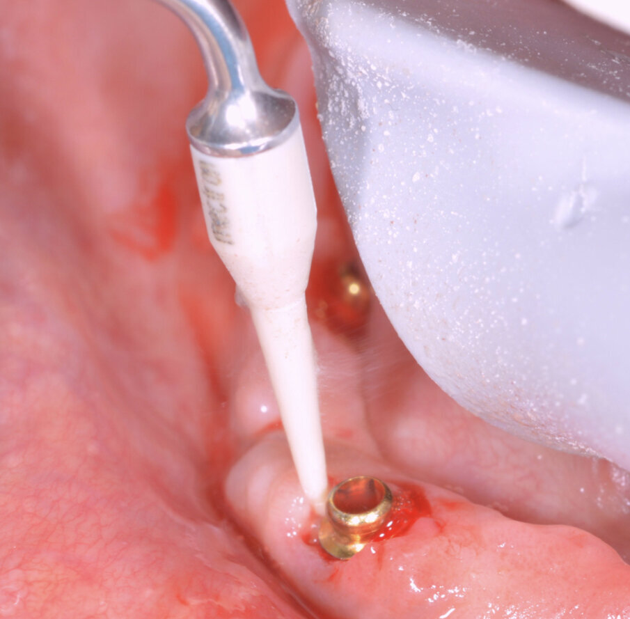 Fig. 10_Rimozione della placca con strumenti in Peek che non rovinano l’abutment.