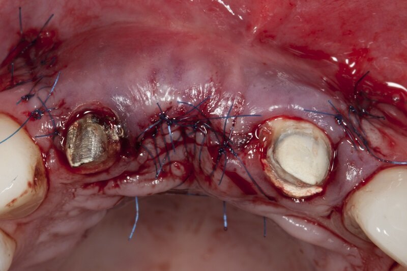 Ryc. 12_Zabieg regeneracji kostnej.