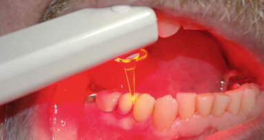 LED als alternative Behandlungsmethode zum Laser?