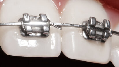 Digitální Flash-Free Bonding: další evoluční krok při nasazení zámků