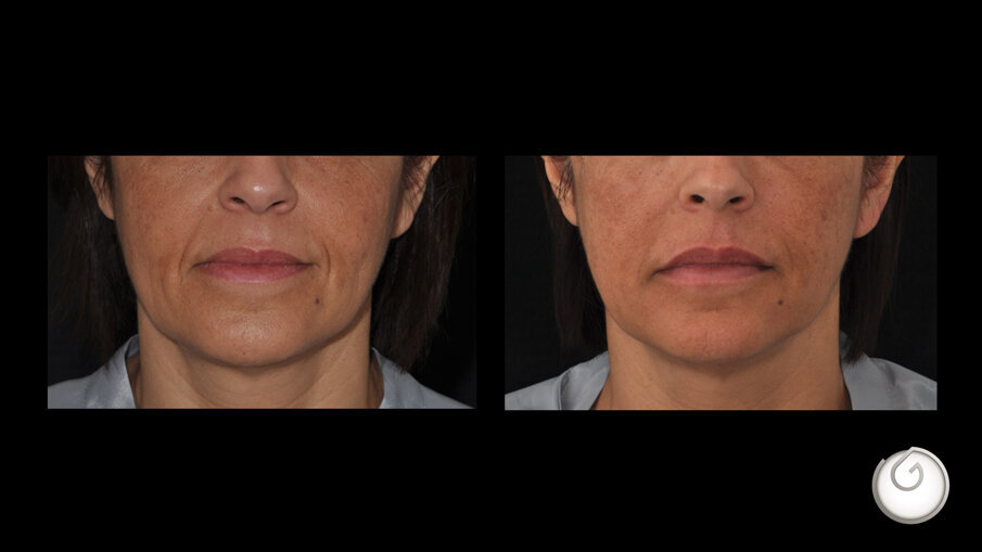 Prima e dopo il trattamento