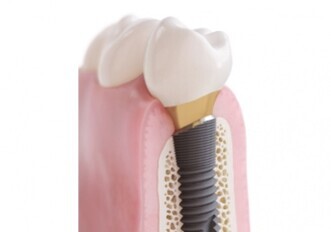 Dentsply Sirona – OsseoSpeed Profile implants