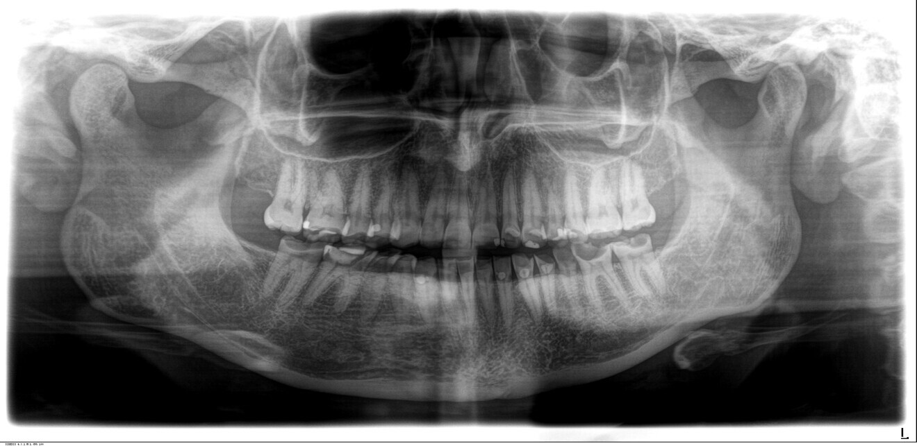 Fig. 1f: Dental panoramic tomogram.