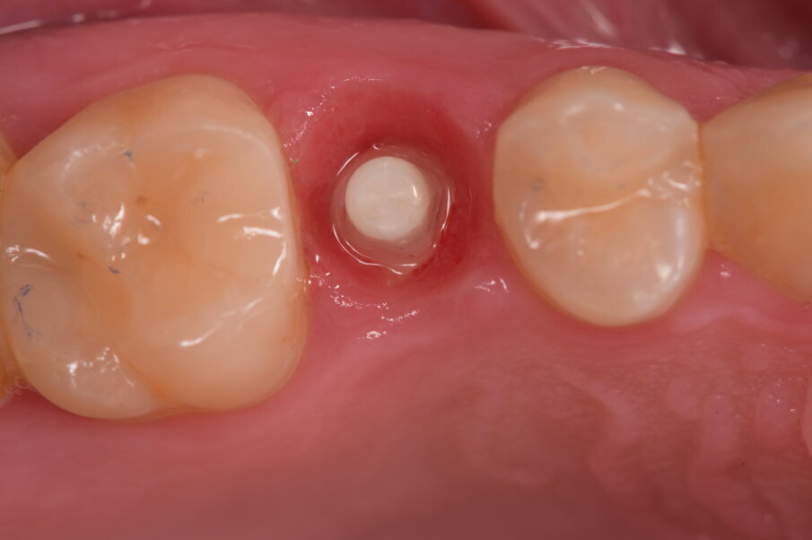 Fig. 7_Dopo 3 mesi siamo soliti eseguire un controllo radiografico e di conseguenza si rimuove il provvisorio e rivalutando il contorno 	mucogengivale perimplantare, in caso di necessita si interviene nella modifica del provvisorio.