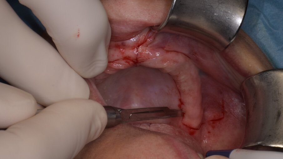 Obr. 8a, b: Druhá horizontální augmentace na pravé straně (a) a na levé straně (b) s již zavedenými implantáty.