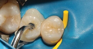 Retraitement endodontique et restauration collée d’une seconde prémolaire structuralement compromise