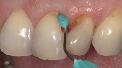 Empirical comparative study confirms thixotropic wound dressing for haemostasis