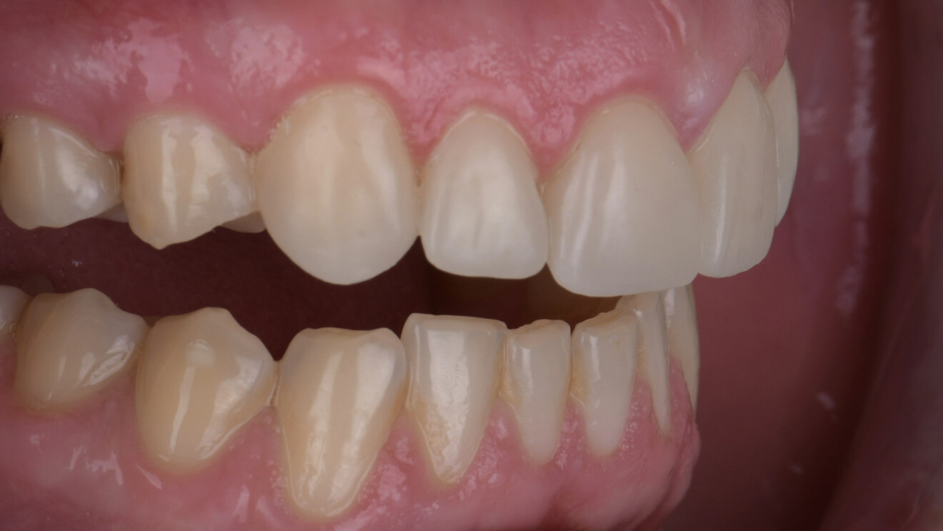 Fig. 8c: Right lateral intra-oral views with the teeth apart showing the veneer morphology and integration with the adjacent dentition.