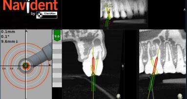 Navident obtains regulatory approvals for guiding root canal treatment