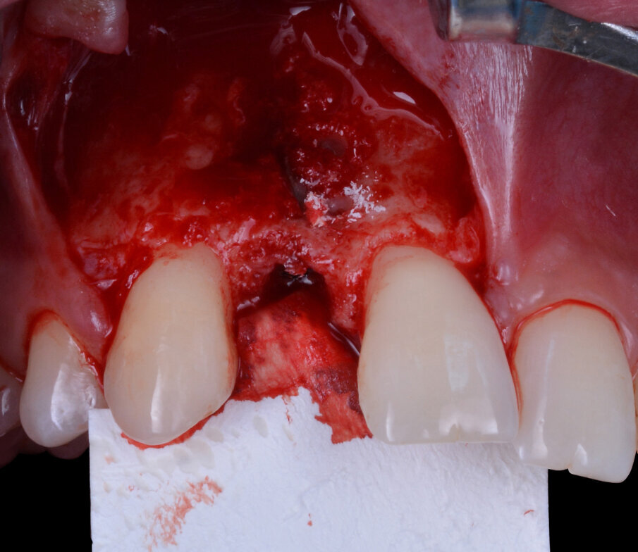 Fig. 7 - Osso autologo particolato ottenuto durante l’esecuzione di fori di osteopromozione.