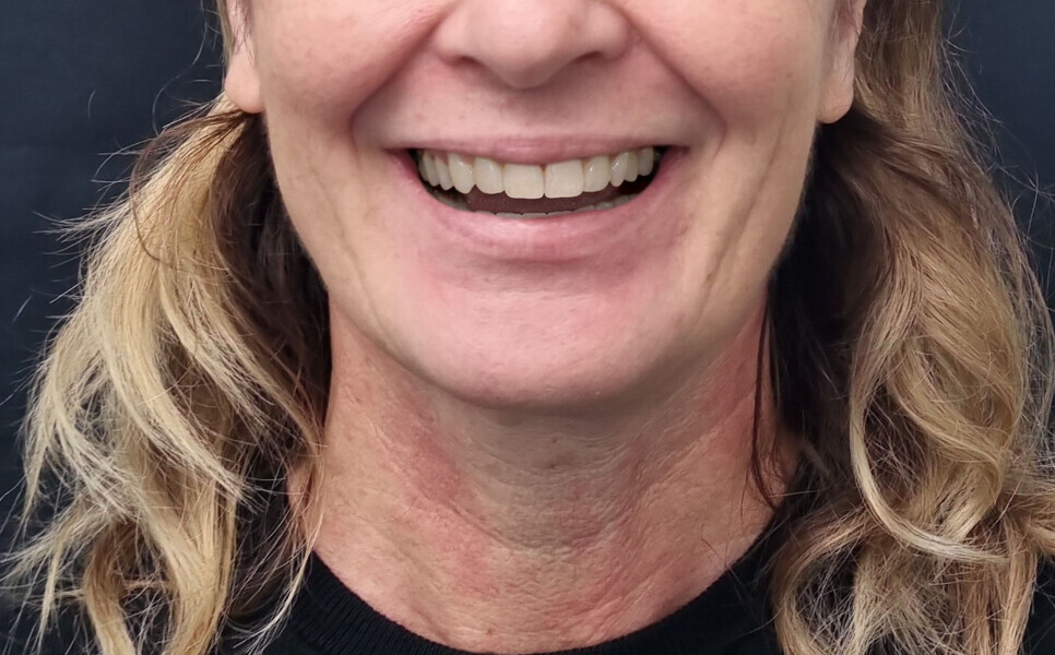 Fig. 7: Virtual simulation of the smile after the planned alignment and restorations.