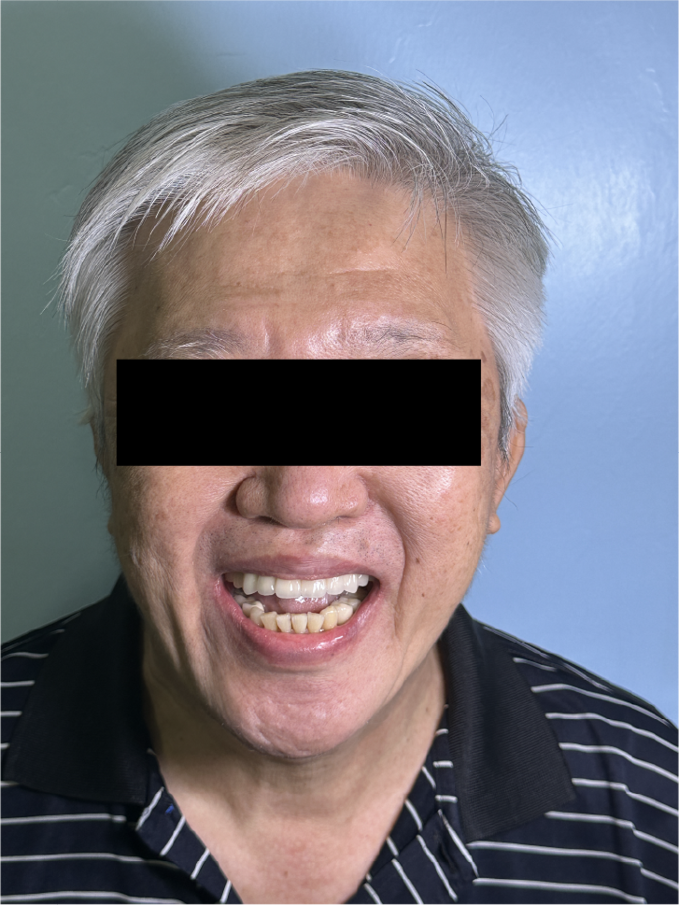 Fig. 5d: Post-treatment facial view demonstrating improved smile aesthetics 