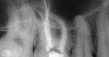 The real state of endodontic instrumentation