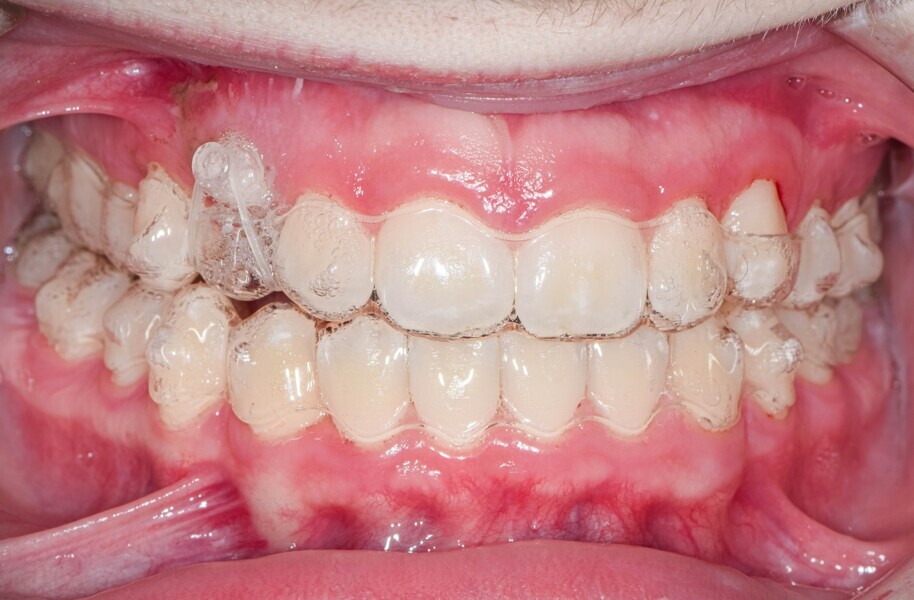 Fig. 5: Progress photographs showing a clear Precision Aligner Button which the surgeon attached to the canine. Notches were placed for the bootstrap elastic on the lingual aspect of the maxillary lateral incisor and first premolar, using the Tear Drop instrument.