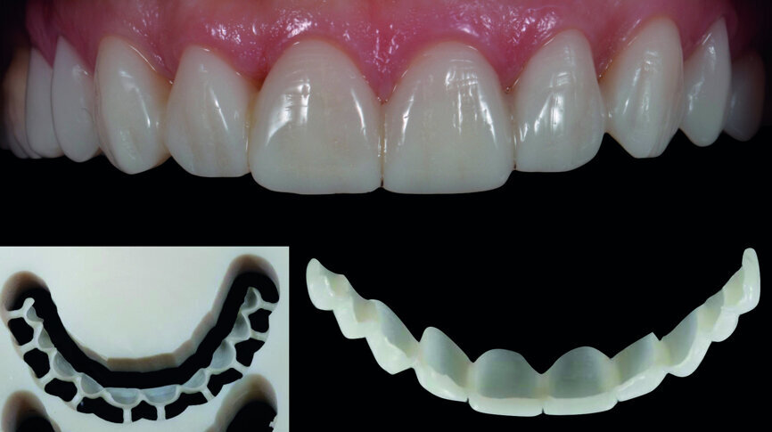 Fig. 12b: Provisional restorations intraorally (Telio CAD).