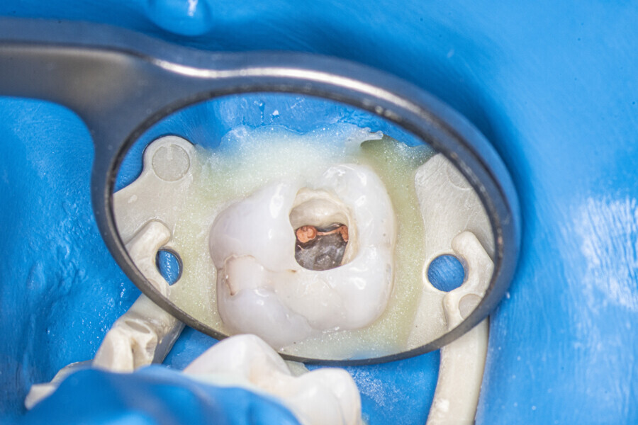 Fig. 44: The MB1 and MB2 canals and isthmus filled with warm gutta-percha.