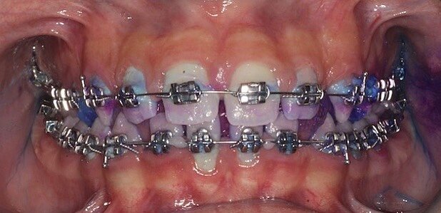 Fig. 1 - Case report di ortodonzia tradizionale. Fotografia frontale a t0 con rilevatore di placca.