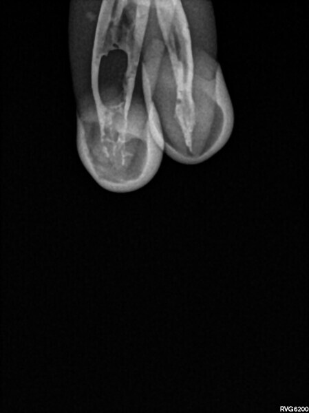 Fig. 2: Post-op radiograph of the same mandibular molar showing the isthmus, ramifications and lateral canals filled with the sealer.