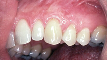 Cosmetic periodontal surgery: Barriers of success Cosmetic periodontal surgery: Barriers of success