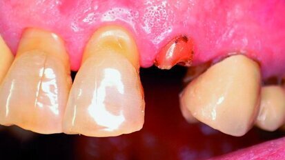 Facteurs de réussite de l’implantation immédiate avec mise en charge immédiate -  Une étude de cas