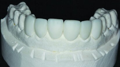 Sans stress (vraiment !)Facettes en résine nanocéramique
