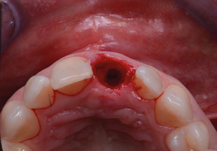 Fig. 5a : Après l’extraction