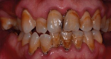 Carie e brown spot: il recupero dell’estetica del sorriso tra debridment, sbiancamento, infiltrazioni, ricostruzioni. Case report