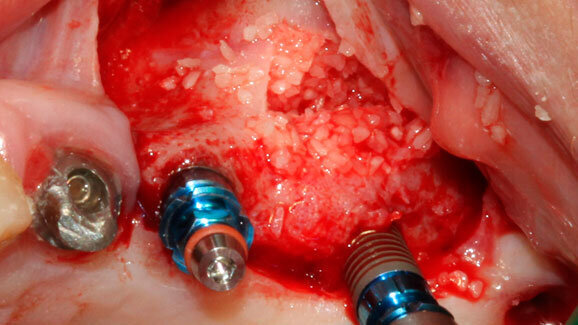 Rialzo di seno mascellare per via laterale  con l’utilizzo di PRGF®-Endoret® e di Hypro-Oss®