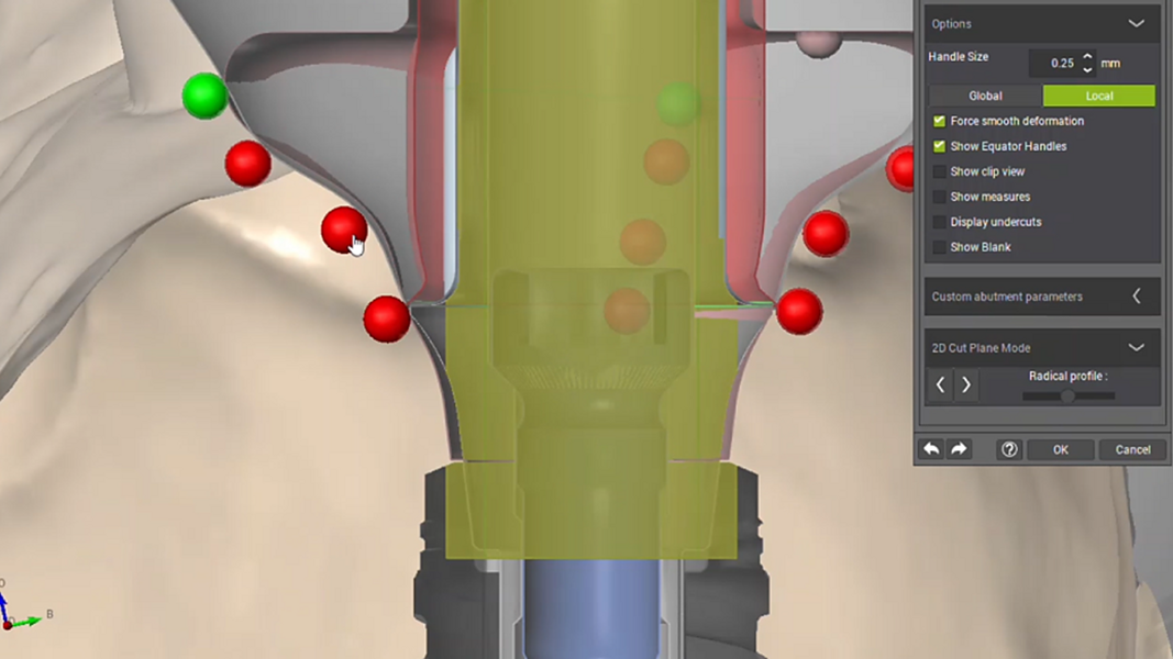 Fig. 14: Design of the definitive crown, mirroring the emergence profile of the Straumann Anatomic Healing Abutment XC.