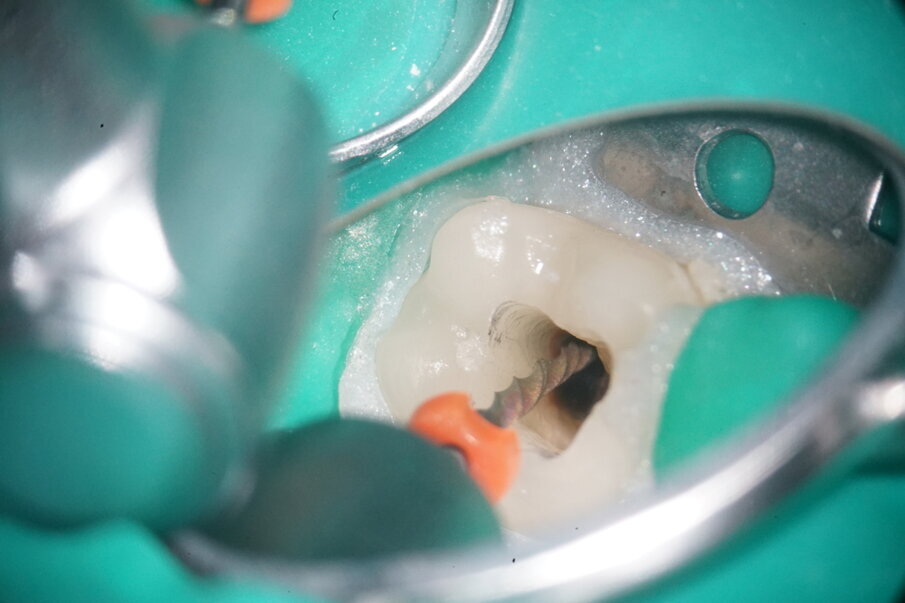 Fig. 8: Preparation with the universal OneFile in the canal.