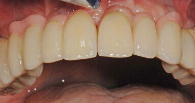 Edentulism: Implant prosthesis therapies designed to optimize function, esthetics