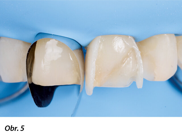 Klinický stav po dostavbě aproximálních stěn zubu 21.