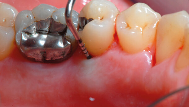 Il laser a Diodo non funziona come monoterapia. Caso clinico