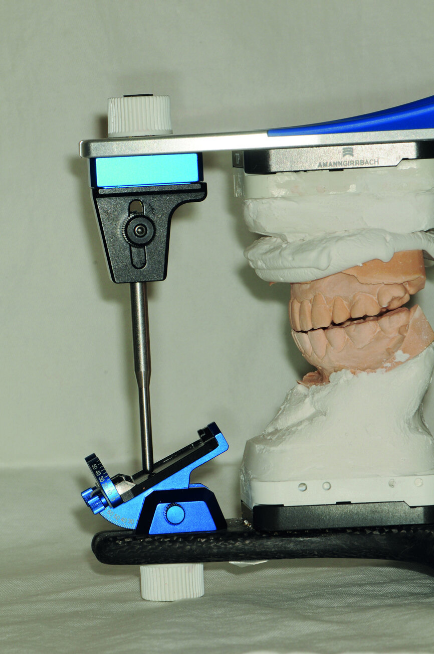 Fig. 27: According to the anterior guidance of the provisional restoration, the individual incisal guide table was set.