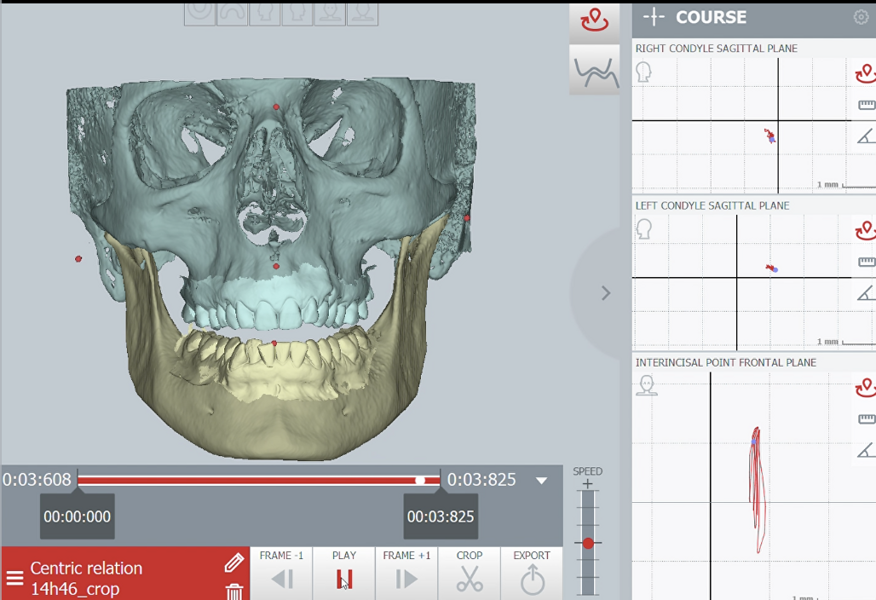 Fig. 43: Condylar and incisor graph recordings of the arc of closure after splint therapy.