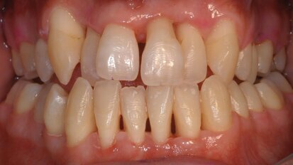 Le laser Er:YAG en maintenance parodontale sur les sites à risque