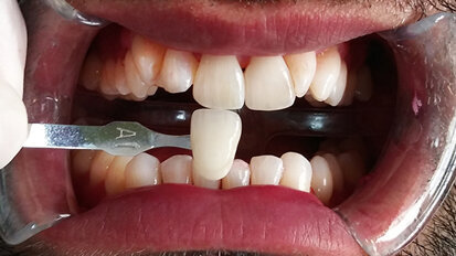 El blanqueamiento posterior a la higiene ahora es un tratamiento al alcance de todos