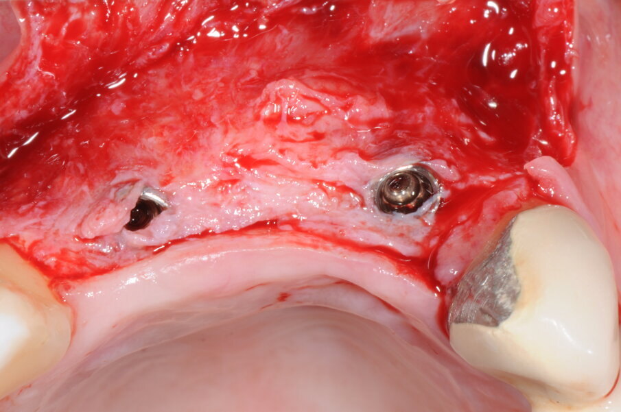 Fig. 20 - Scopertura degli impianti.