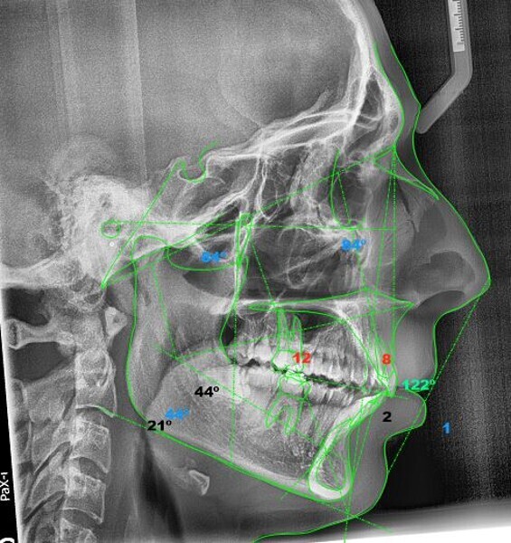 Fig. 20: Ricketts cephalometric analysis after the orthodontic treatment (image generated using NemoCeph Studio).