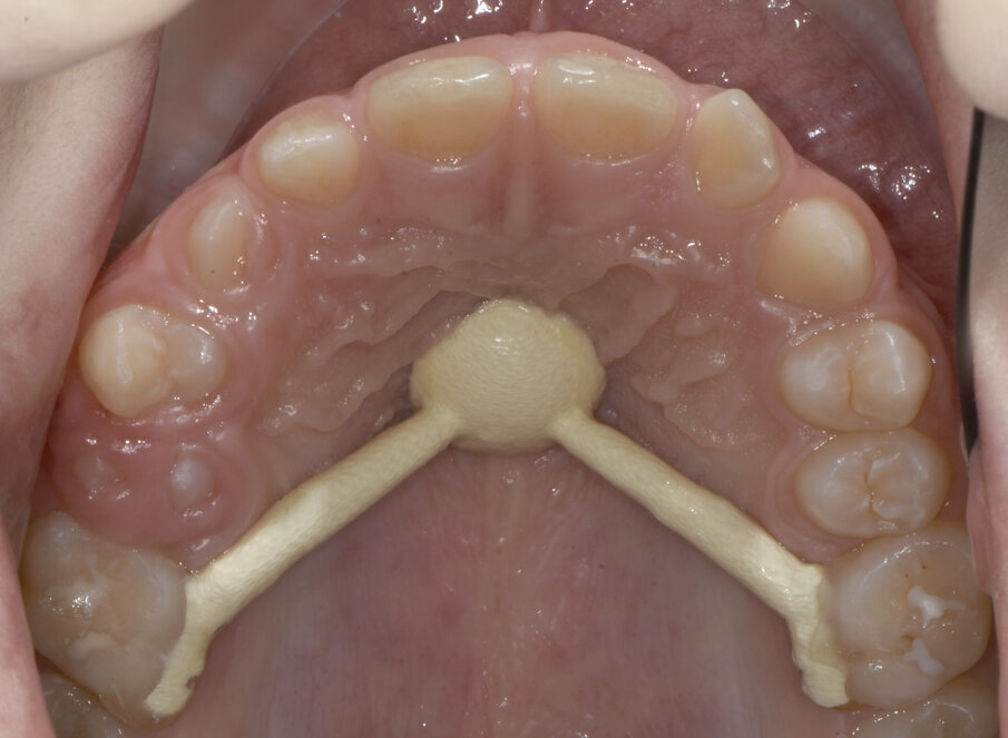 Fig. 28_Normalizzazione della permuta.