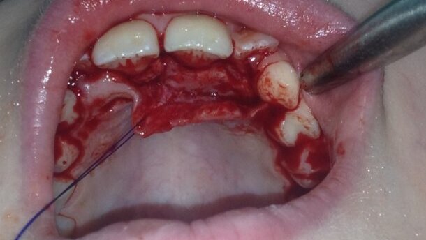 Standard postępowania przy operacyjnym usunięciu mesiodensu od strony podniebiennej