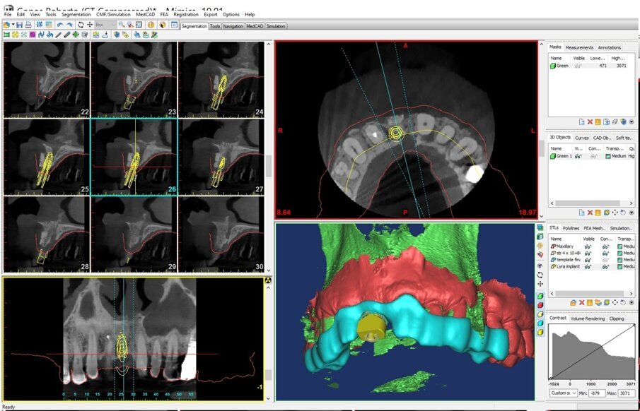 Fig. 10_Controllo della qualità della pianificazione olografica in software certificato (MIMICS, Materialise). 